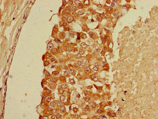 Immunohistochemistry of paraffin-embedded human breast cancer using GFRA1 Antibody at dilution of 1:100Rabbit anti-Human GFRA1 Polyclonal Antibody
