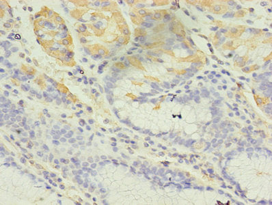 Immunohistochemistry of paraffin-embedded human gastric cancer using CBLIF Antibody at dilution of 1:100