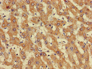 Immunohistochemistry of paraffin-embedded human liver cancer using GIPC1 Antibody at dilution of 1:100Rabbit anti-Human GIPC1 Polyclonal Antibody