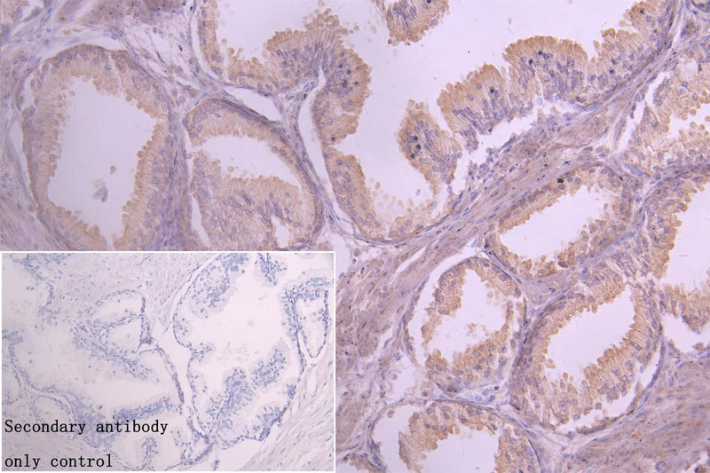 Immunohistochemistry of paraffin-embedded human prostate cancer using GIPR Antibody at dilution of 1:100Rabbit anti-Human GIPR Polyclonal Antibody