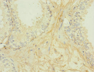 Immunohistochemistry of paraffin-embedded human prostate cancer using the antibody at dilution of 1:100Rabbit anti-Human GIPR Polyclonal Antibody