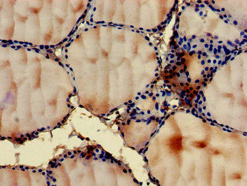 Immunohistochemistry of paraffin-embedded human thyroid tissue using GIT1 Antibody at dilution of 1:100Rabbit anti-Human GIT1 Polyclonal Antibody