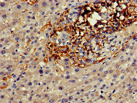 Immunohistochemistry of paraffin-embedded human liver cancer using GJA8 Antibody at dilution of 1:100Rabbit anti-Human GJA8 Polyclonal Antibody