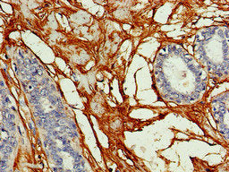 Immunohistochemistry of paraffin-embedded human breast cancer using GJA8 Antibody at dilution of 1:100Rabbit anti-Human GJA8 Polyclonal Antibody