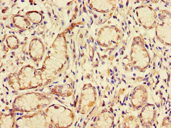 Immunohistochemistry of paraffin-embedded human gastric cancer using GJB2 Antibody at dilution of 1:100Rabbit anti-Human GJB2 Polyclonal Antibody