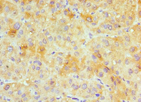 Immunohistochemistry of paraffin-embedded human liver cancer using GJC1 Antibody at dilution of 1:100Rabbit anti-Human GJC1 Polyclonal Antibody