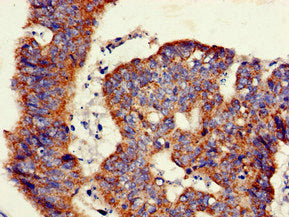 Immunohistochemistry of paraffin-embedded human colon cancer using the antibody at dilution of 1:100Rabbit anti-Human GLB1 Polyclonal Antibody