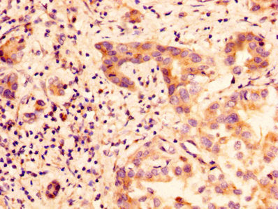 IHC image of GLIPR1 Antibody diluted at 1:100 and staining in paraffin-embedded human liver cancer performed on a Leica BondTM system. After dewaxing and hydration, antigen retrieval was mediated by high pressure in a citrate buffer (pH 6.0). Section was blocked with 10% normal goat serum 30min at RT. Then primary antibody (1% BSA) was incubated at 4°C overnight. The primary is detected by a biotinylated secondary antibody and visualized using an HRP conjugated SP system.Rabbit anti-Human GLIPR1 Polyclonal Antibody