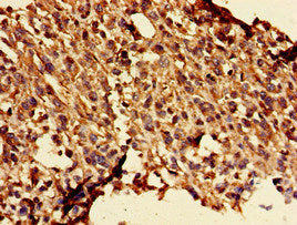 Immunohistochemistry of paraffin-embedded human melanoma using GLRA1 Antibody at dilution of 1:100Rabbit anti-Human GLRA1 Polyclonal Antibody