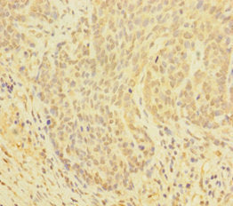 Immunohistochemistry of paraffin-embedded human ovarian cancer using the antibody at dilution of 1:100Rabbit anti-Human GLRX Polyclonal Antibody