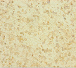 Immunohistochemistry of paraffin-embedded human glioma using GLRX Antibody at dilution of 1:100Rabbit anti-Human GLRX Polyclonal Antibody