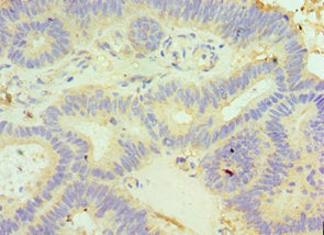 Immunohistochemistry of paraffin-embedded human colon cancer using GLRX3 Antibody at dilution of 1:100Rabbit anti-Human GLRX3 Polyclonal Antibody