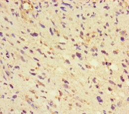 Immunohistochemistry of paraffin-embedded human glioma using the antibody at dilution of 1:100Rabbit anti-Human GLUL Polyclonal Antibody