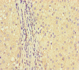 Immunohistochemistry of paraffin-embedded human liver cancer using GLUL Antibody at dilution of 1:100Rabbit anti-Human GLUL Polyclonal Antibody