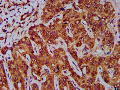 IHC image of GNA12 Antibody diluted at 1:400 and staining in paraffin-embedded human liver cancer performed on a Leica BondTM system. After dewaxing and hydration, antigen retrieval was mediated by high pressure in a citrate buffer (pH 6.0). Section was blocked with 10% normal goat serum 30min at RT. Then primary antibody (1% BSA) was incubated at 4°C overnight. The primary is detected by a biotinylated secondary antibody and visualized using an HRP conjugated SP system.Rabbit anti-Human GNA12 Polyclonal Antibody