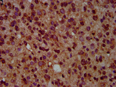 IHC image of GNAL Antibody diluted at 1:500 and staining in paraffin-embedded human glioma performed on a Leica BondTM system. After dewaxing and hydration, antigen retrieval was mediated by high pressure in a citrate buffer (pH 6.0). Section was blocked with 10% normal goat serum 30min at RT. Then primary antibody (1% BSA) was incubated at 4°C overnight. The primary is detected by a biotinylated secondary antibody and visualized using an HRP conjugated SP system.Rabbit anti-Human GNAL Polyclonal Antibody