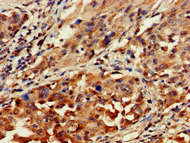 Immunohistochemistry of paraffin-embedded human lung cancer using GNAT1 Antibody at dilution of 1:100Rabbit anti-Human GNAT1 Polyclonal Antibody