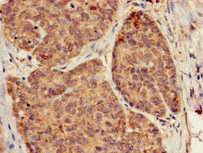 Immunohistochemistry of paraffin-embedded human ovarian cancer using GNB5 Antibody at dilution of 1:100Rabbit anti-Human GNB5 Polyclonal Antibody