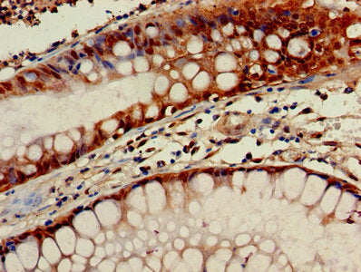 Immunohistochemistry of paraffin-embedded human colon cancer using the antibody at dilution of 1:100Rabbit anti-Human GNG10 Polyclonal Antibody