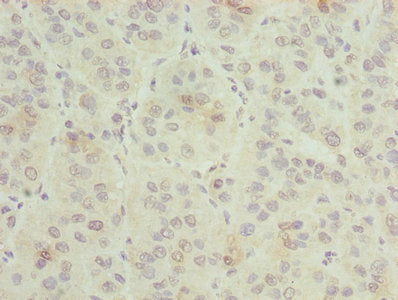 Immunohistochemistry of paraffin-embedded human liver cancer using the antibody at dilution of 1:100Rabbit anti-Human GNG5 Polyclonal Antibody