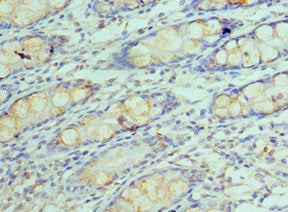 Immunohistochemistry of paraffin-embedded human colon tissue using GOLM1 Antibody at dilution of 1:100Rabbit anti-Human GOLM1 Polyclonal Antibody