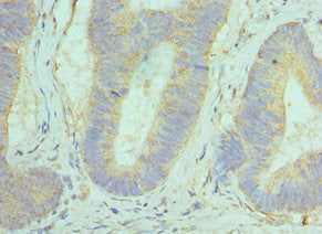 Immunohistochemistry of paraffin-embedded human colon cancer using GOLM1 Antibody at dilution of 1:100Rabbit anti-Human GOLM1 Polyclonal Antibody