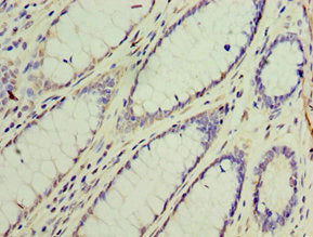 Immunohistochemistry of paraffin-embedded human colon cancer using GOSR1 Antibody at dilution of 1:100Rabbit anti-Human GOSR1 Polyclonal Antibody