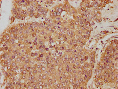 IHC image of the antibody diluted at 1:250 and staining in paraffin-embedded human liver cancer performed on a Leica BondTM system. After dewaxing and hydration, antigen retrieval was mediated by high pressure in a citrate buffer (pH 6.0). Section was blocked with 10% normal goat serum 30min at RT. Then primary antibody (1% BSA) was incubated at 4°C overnight. The primary is detected by a biotinylated secondary antibody and visualized using an HRP conjugated SP system.Rabbit anti-Human GOT1 Polyclonal Antibody