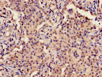 Immunohistochemistry of paraffin-embedded human lung cancer using the antibody at dilution of 1:100Rabbit anti-Human GP9 Polyclonal Antibody