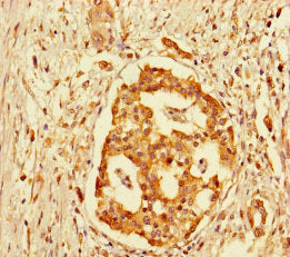 Immunohistochemistry of paraffin-embedded human pancreatic cancer using the antibody at dilution of 1:100Rabbit anti-Human GPR183 Polyclonal Antibody