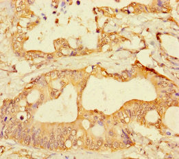 Immunohistochemistry of paraffin-embedded human colon cancer using GPR183 Antibody at dilution of 1:100Rabbit anti-Human GPR183 Polyclonal Antibody