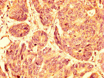 IHC image of GPR32 Antibody diluted at 1:500 and staining in paraffin-embedded human gastric cancer performed on a Leica BondTM system. After dewaxing and hydration, antigen retrieval was mediated by high pressure in a citrate buffer (pH 6.0). Section was blocked with 10% normal goat serum 30min at RT. Then primary antibody (1% BSA) was incubated at 4°C overnight. The primary is detected by a biotinylated secondary antibody and visualized using an HRP conjugated SP system.Rabbit anti-Human GPR32 Polyclonal Antibody