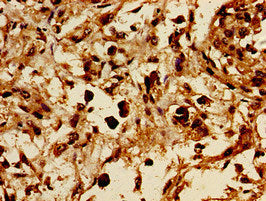 Immunohistochemistry of paraffin-embedded human melanoma using the antibody at dilution of 1:100Rabbit anti-Human GRB10 Polyclonal Antibody