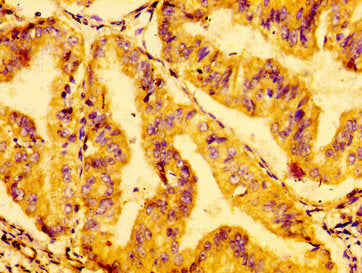 IHC image of the antibody diluted at 1:100 and staining in paraffin-embedded human cervical cancer performed on a Leica BondTM system. After dewaxing and hydration, antigen retrieval was mediated by high pressure in a citrate buffer (pH 6.0). Section was blocked with 10% normal goat serum 30min at RT. Then primary antibody (1% BSA) was incubated at 4°C overnight. The primary is detected by a biotinylated secondary antibody and visualized using an HRP conjugated SP system.Rabbit anti-Human GRB14 Polyclonal Antibody