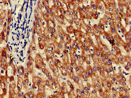 Immunohistochemistry of paraffin-embedded human liver tissue using GRHPR Antibody at dilution of 1:100Rabbit anti-Human GRHPR Polyclonal Antibody