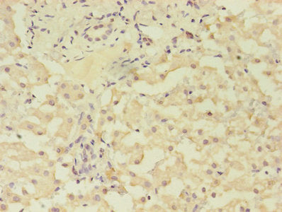 Immunohistochemistry of paraffin-embedded human liver cancer using GRK4 Antibody at dilution of 1:100