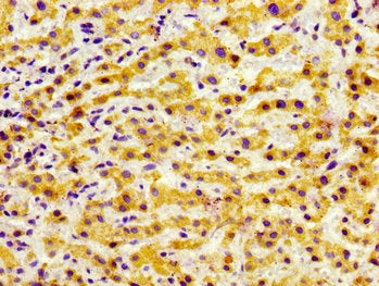Immunohistochemistry of paraffin-embedded human liver cancer using GRK5 Antibody at dilution of 1:100Rabbit anti-Human GRK5 Polyclonal Antibody