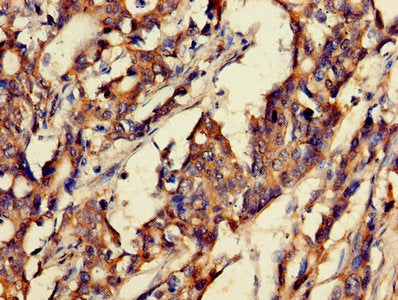 Immunohistochemistry of paraffin-embedded human gastric cancer using GRP Antibody at dilution of 1:100Rabbit anti-Human GRP Polyclonal Antibody