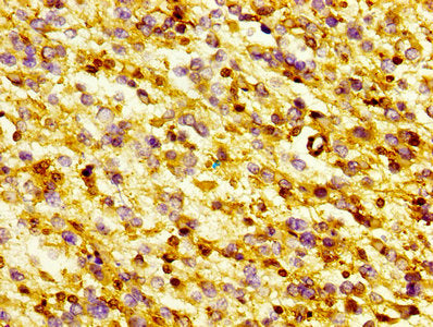 IHC image of GSN Antibody diluted at 1:300 and staining in paraffin-embedded human glioma performed on a Leica BondTM system. After dewaxing and hydration, antigen retrieval was mediated by high pressure in a citrate buffer (pH 6.0). Section was blocked with 10% normal goat serum 30min at RT. Then primary antibody (1% BSA) was incubated at 4°C overnight. The primary is detected by a biotinylated secondary antibody and visualized using an HRP conjugated SP system.Rabbit anti-Human GSN Polyclonal Antibody