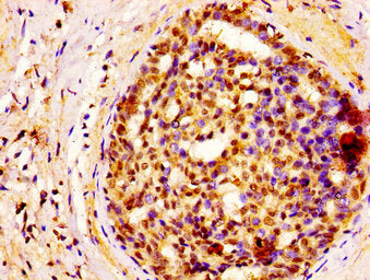 IHC image of the antibody diluted at 1:400 and staining in paraffin-embedded human breast cancer performed on a Leica BondTM system. After dewaxing and hydration, antigen retrieval was mediated by high pressure in a citrate buffer (pH 6.0). Section was blocked with 10% normal goat serum 30min at RT. Then primary antibody (1% BSA) was incubated at 4°C overnight. The primary is detected by a biotinylated secondary antibody and visualized using an HRP conjugated SP system.Rabbit anti-Human GSPT1 Polyclonal Antibody
