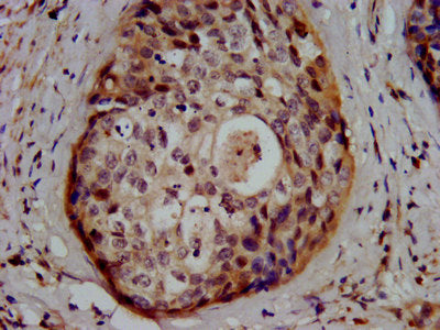 IHC image of GSS Antibody diluted at 1:500 and staining in paraffin-embedded human cervical cancer performed on a Leica BondTM system. After dewaxing and hydration, antigen retrieval was mediated by high pressure in a citrate buffer (pH 6.0). Section was blocked with 10% normal goat serum 30min at RT. Then primary antibody (1% BSA) was incubated at 4°C overnight. The primary is detected by a biotinylated secondary antibody and visualized using an HRP conjugated SP system.Rabbit anti-Human GSS Polyclonal Antibody