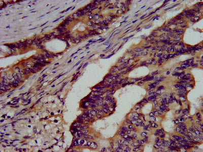 IHC image of GSS Antibody diluted at 1:500 and staining in paraffin-embedded human colon cancer performed on a Leica BondTM system. After dewaxing and hydration, antigen retrieval was mediated by high pressure in a citrate buffer (pH 6.0). Section was blocked with 10% normal goat serum 30min at RT. Then primary antibody (1% BSA) was incubated at 4°C overnight. The primary is detected by a biotinylated secondary antibody and visualized using an HRP conjugated SP system.Rabbit anti-Human GSS Polyclonal Antibody