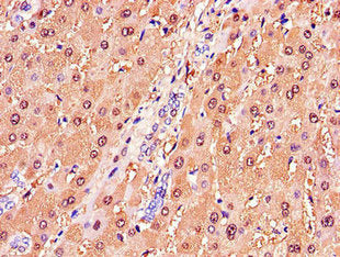 Immunohistochemistry of paraffin-embedded human liver tissue using GSTA1 Antibody at dilution of 1:100Rabbit anti-Human GSTA1 Polyclonal Antibody