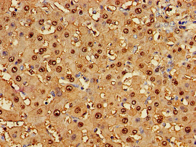 Immunohistochemistry of paraffin-embedded human liver cancer using the antibody at dilution of 1:100Rabbit anti-Human GSTA1 Polyclonal Antibody
