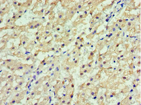 Immunohistochemistry of paraffin-embedded human liver cancer using GSTA2 Antibody at dilution of 1:100Rabbit anti-Human GSTA2 Polyclonal Antibody