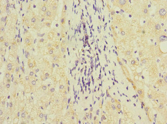Immunohistochemistry of paraffin-embedded human liver cancer using GSTK1 Antibody at dilution of 1:100Rabbit anti-Human GSTK1 Polyclonal Antibody
