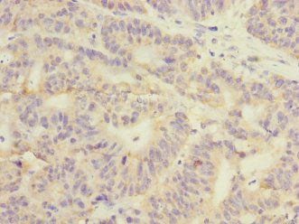 Immunohistochemistry of paraffin-embedded human colon cancer using GSTK1 Antibody at dilution of 1:100Rabbit anti-Human GSTK1 Polyclonal Antibody