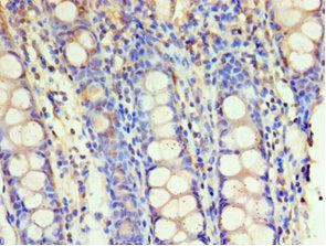 Immunohistochemistry of paraffin-embedded human colon tissue using GSTM4 Antibody at dilution of 1:100Rabbit anti-Human GSTM4 Polyclonal Antibody