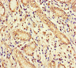 Immunohistochemistry of paraffin-embedded human gastric cancer using GUCY1A1 Antibody at dilution of 1:100Rabbit anti-Human GUCY1A1 Polyclonal Antibody