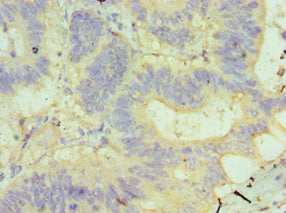 Immunohistochemistry of paraffin-embedded human colon cancer using GUSB Antibody at dilution of 1:100Rabbit anti-Human GUSB Polyclonal Antibody